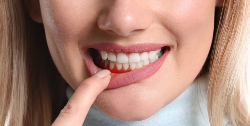Гноится десна после удаления зуба — что делать?