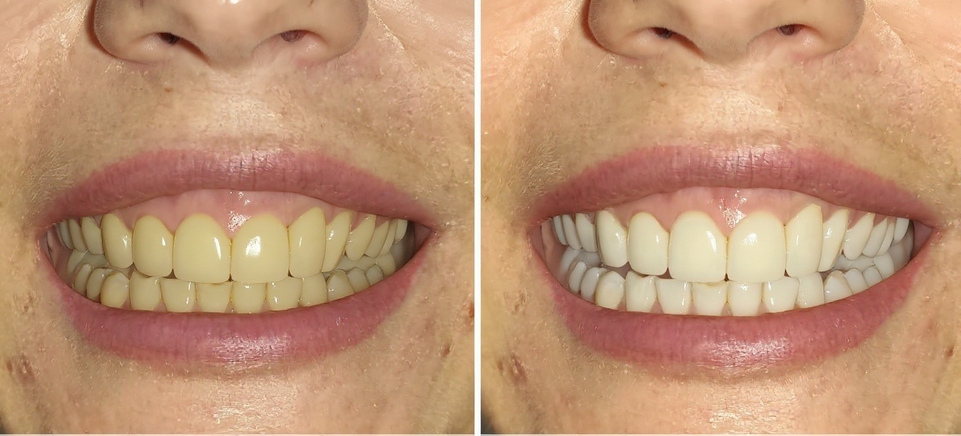 Коронки из диоксида циркония до и после