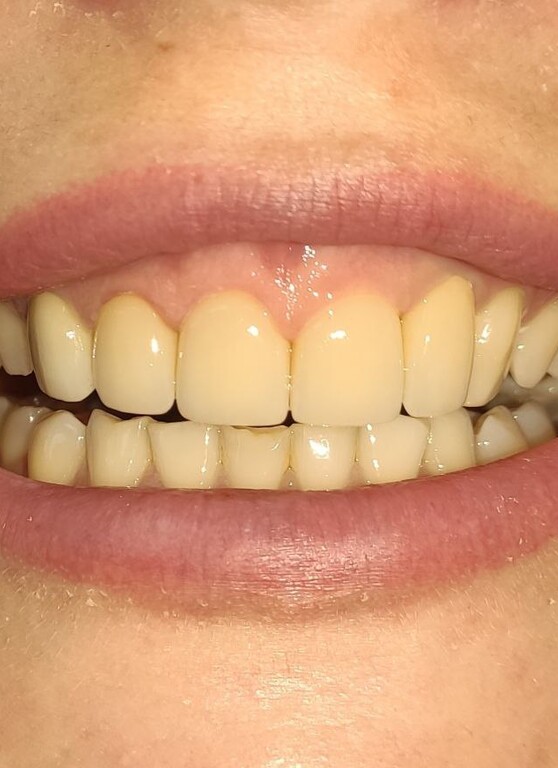 Протезирование цирконием после