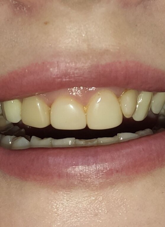 Протезирование цирконием