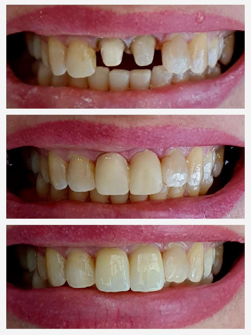 пример работы: коронки из диоксида циркония