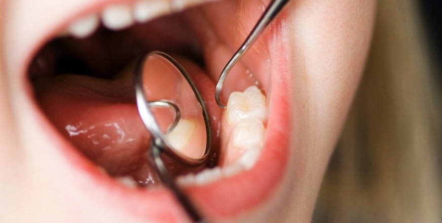 Зубы мудрости: откуда взялись, почему болят и нужно ли удалять