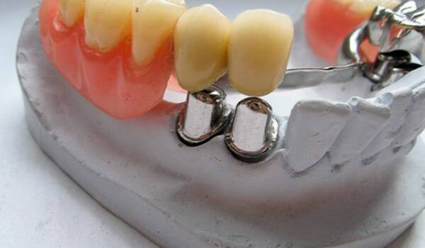 Бюгельные протезы: какие бывают и когда они необходимы