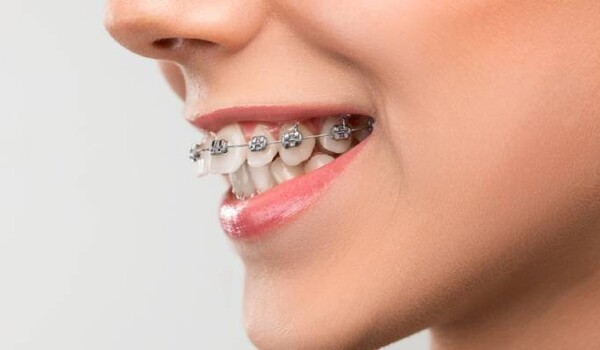 Как правильно чистить зубы с брекетами: советы стоматологов