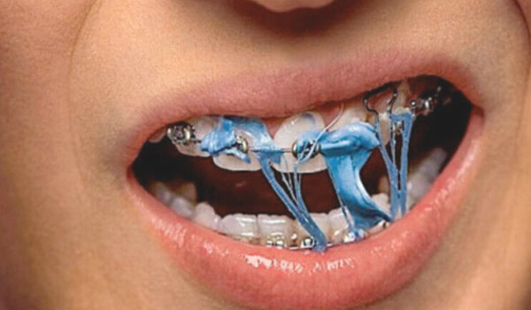 Что можно и нельзя есть после установки брекетов?