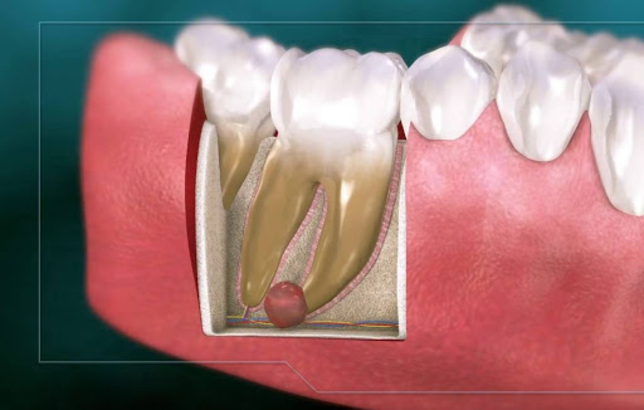 Из-за чего появилась киста зуба и больно ли ее лечить?
