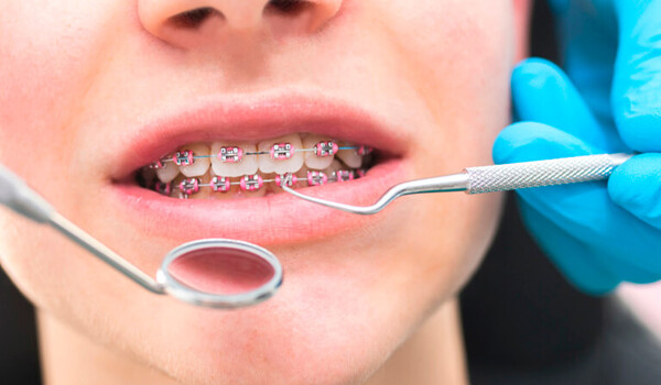 В каких случаях не ставят брекеты?