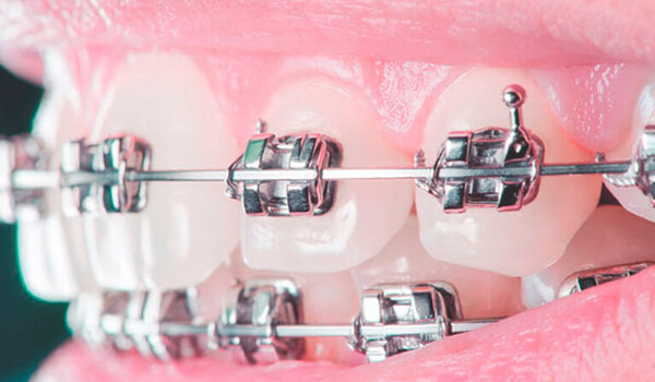 Суть брекетов: зачем их ставят на зубы