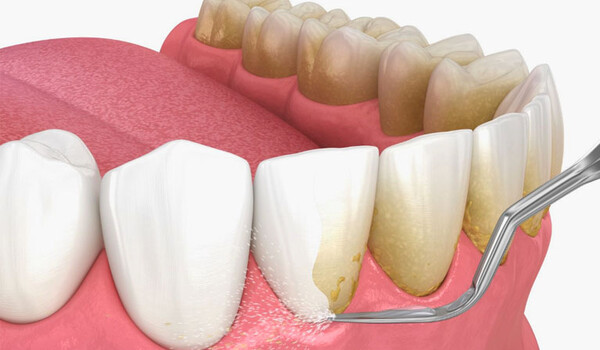 Вред зубного камня: почему его важно удалять и как это сделать