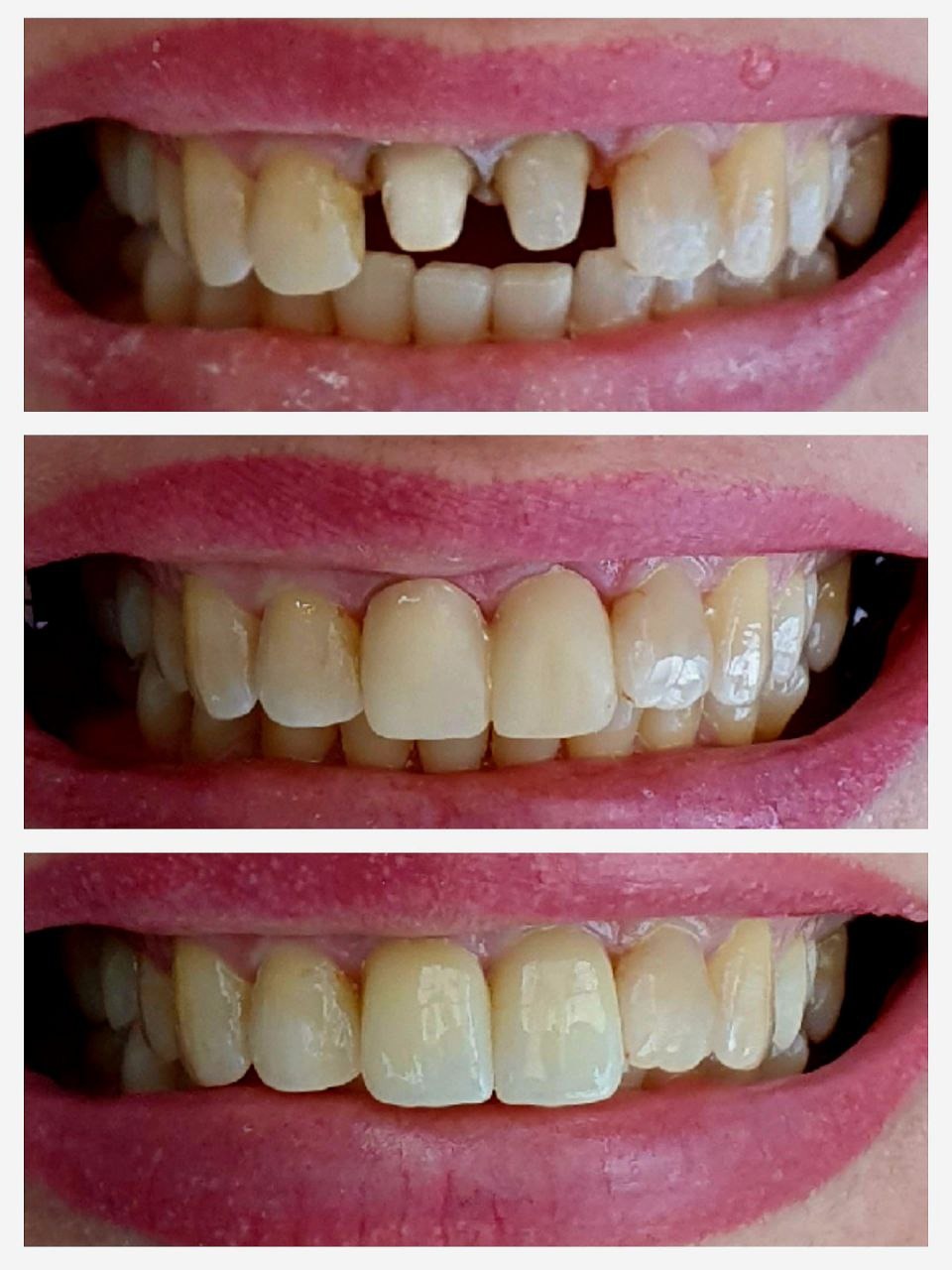 Протезирование коронками  из диоксида циркония