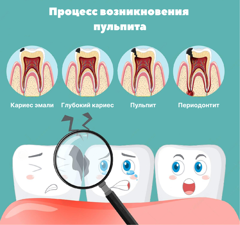 Пульпит Зуба Лечение Цена